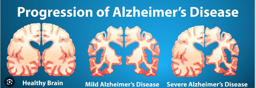 Alzheimers and Homeopathy