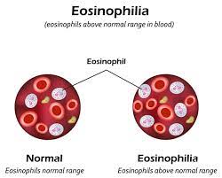 Homeopathic-treatment-for-Eosinophilia