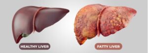 Read more about the article Homeopathic Remedies for Fatty Liver