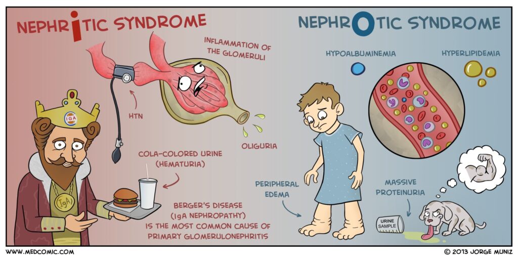 Homeopathy-treatment-for-Nephritic-Nephrotic-Syndrome