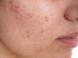 Homeopathic-treatment-for-skin-acne