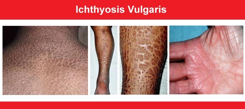 Homeopathic-treatment-for-ichthyosis