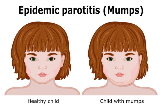 Homeopathic-treatment-for-mumps