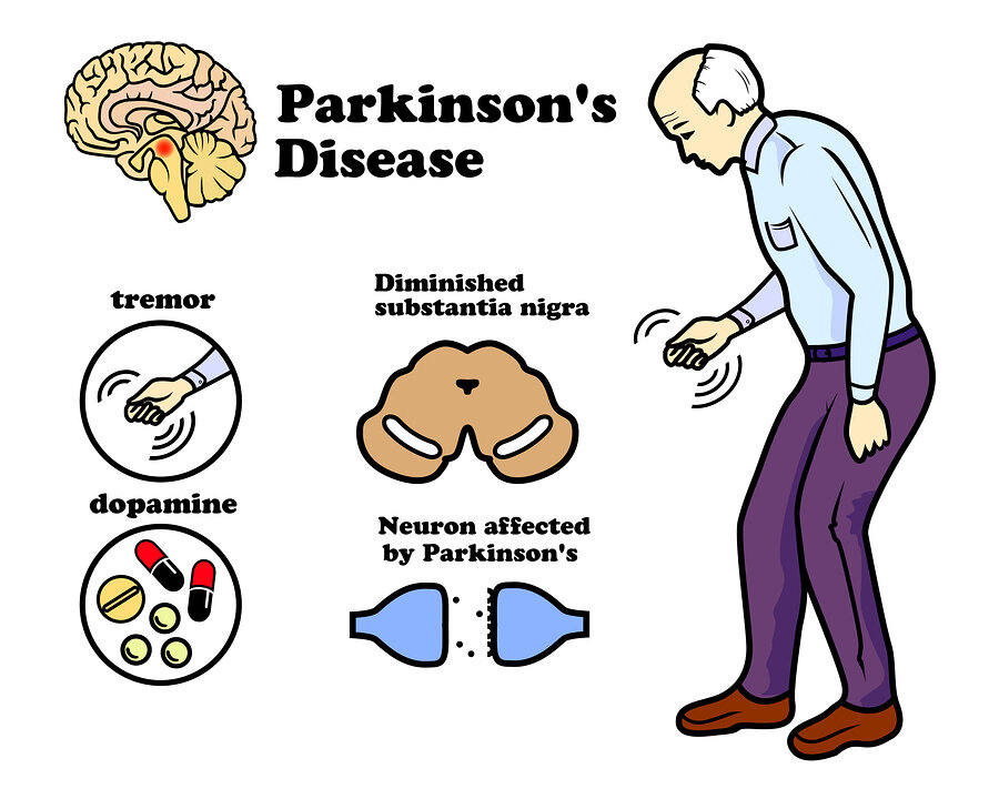 parkinson-disease and homeopathy