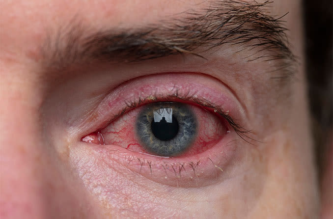 Homeopathic-treatment-for-swollen-eyelids-blepharitis