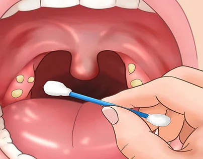 Homeopathic-treatment-for-tonsillitis