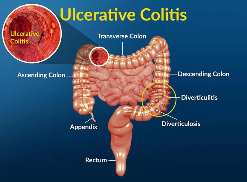 Colitis - HealthKunj Clinics