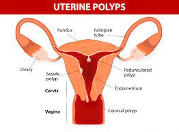 Homeopathic-treatment-for-uterine polyp